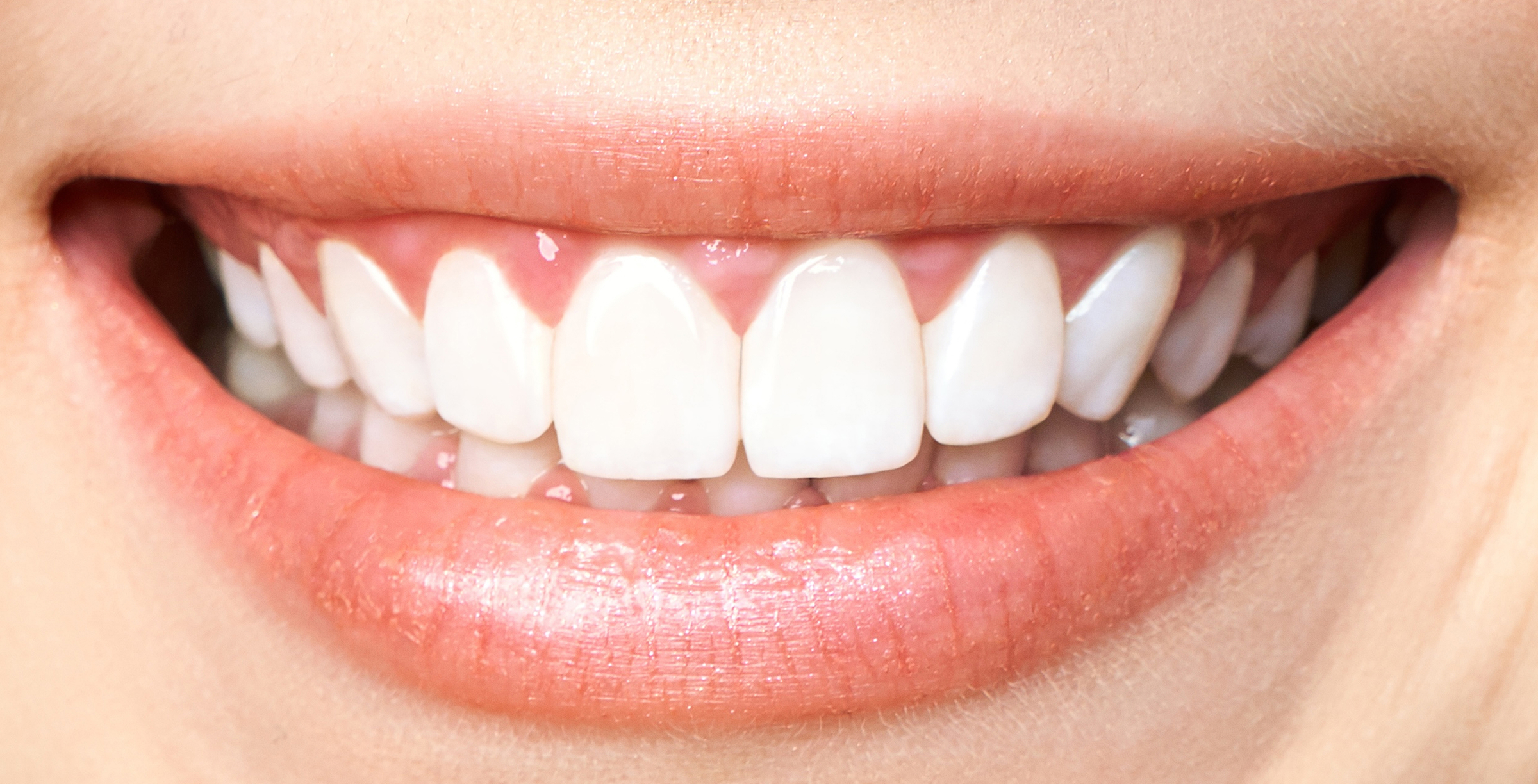 After Image: Teeth Whitening - front