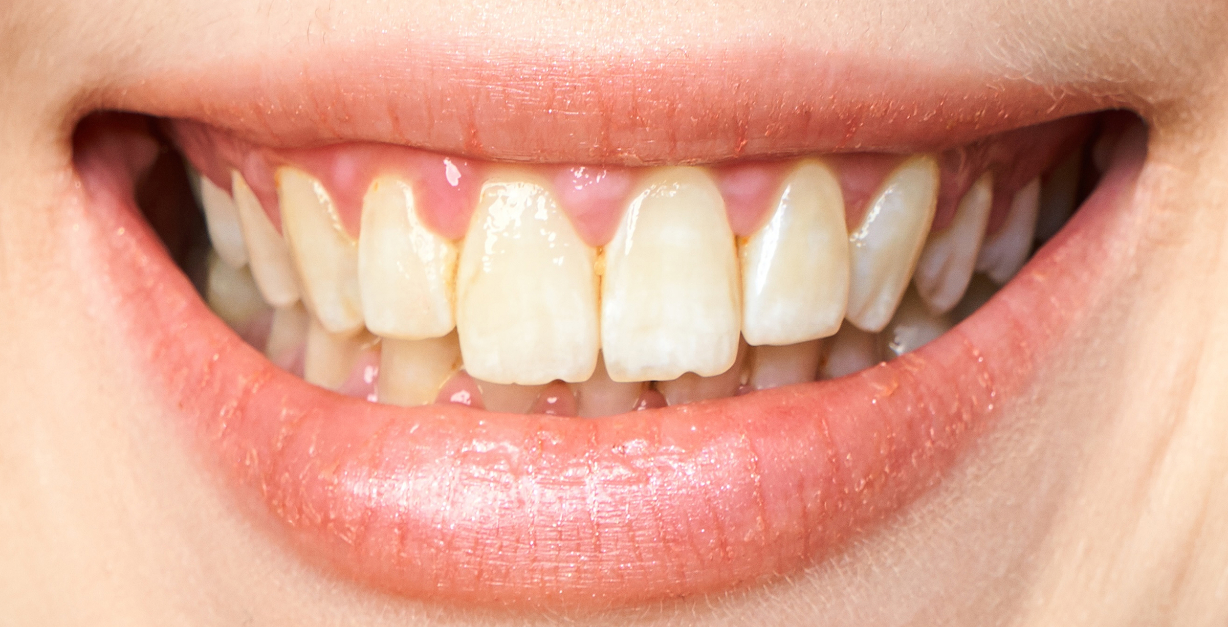 Before Image: Teeth Whitening - front